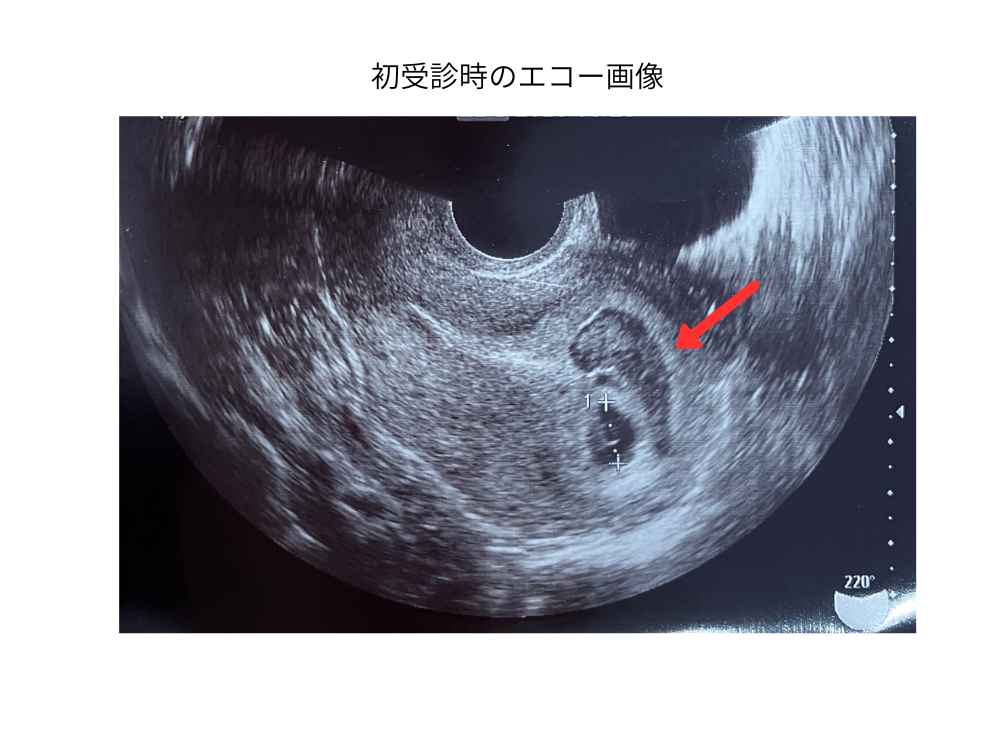 初診時のエコー画像(妊娠5週頃)