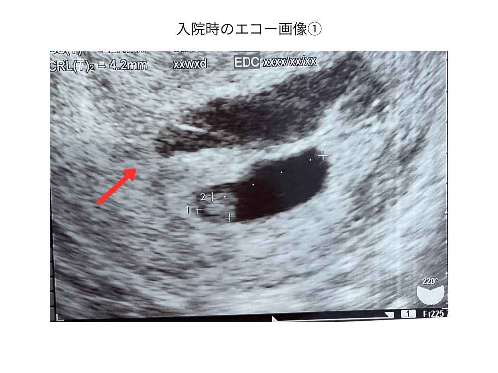 再出血し、入院した直後のエコー画像(妊娠5-6週頃)