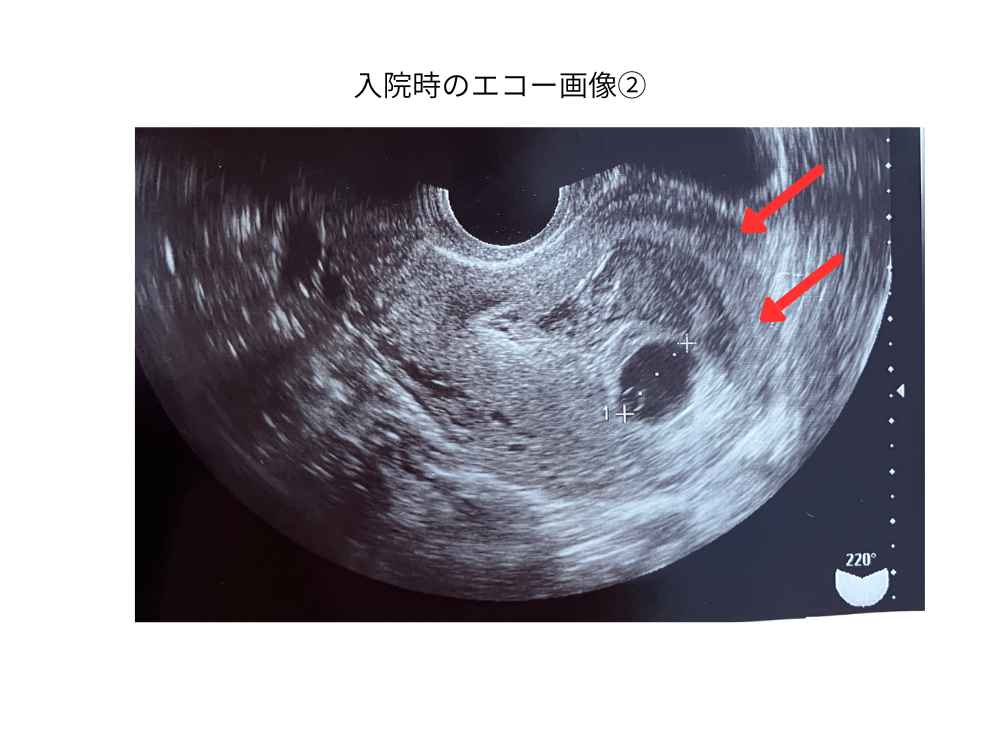 入院して数日後のエコー画像(妊娠６週頃)