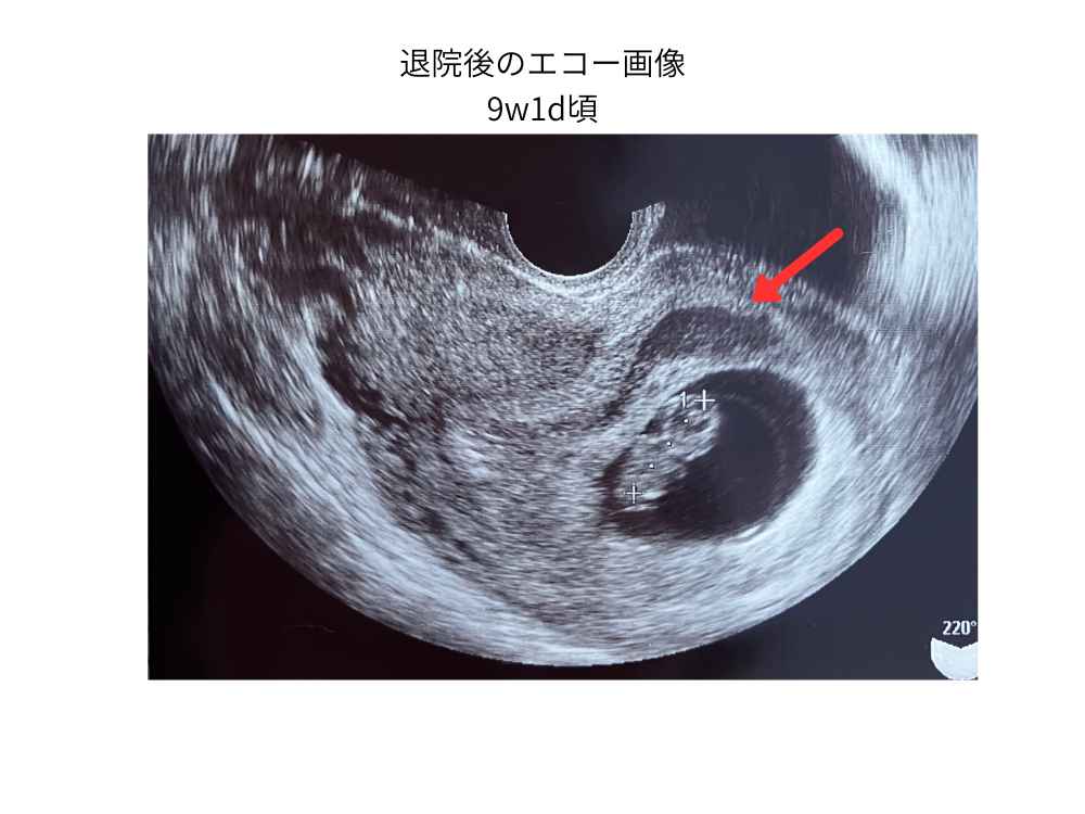退院後のエコー画像(妊娠９週頃)