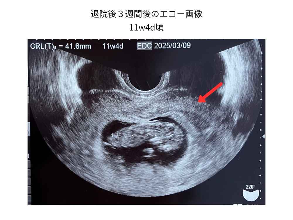 退院後３週間後のエコー画像(妊娠１１週頃）